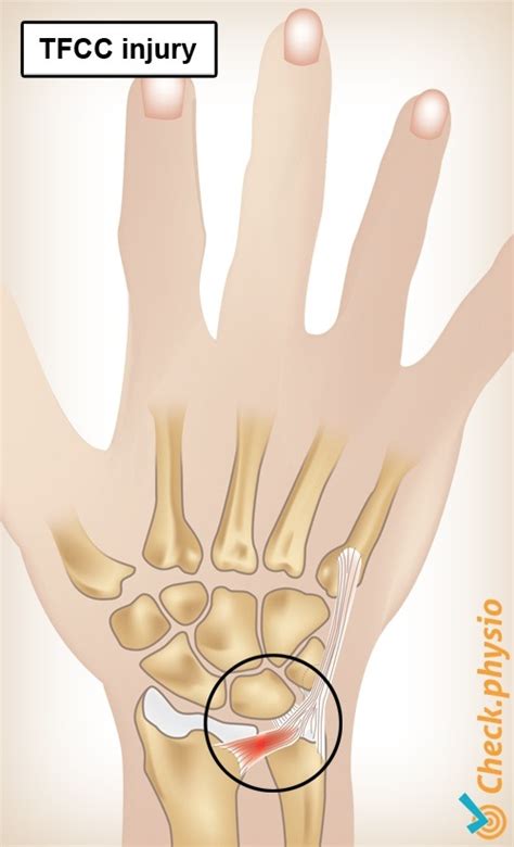 tfcc tear test video|how to fix tfcc injury.